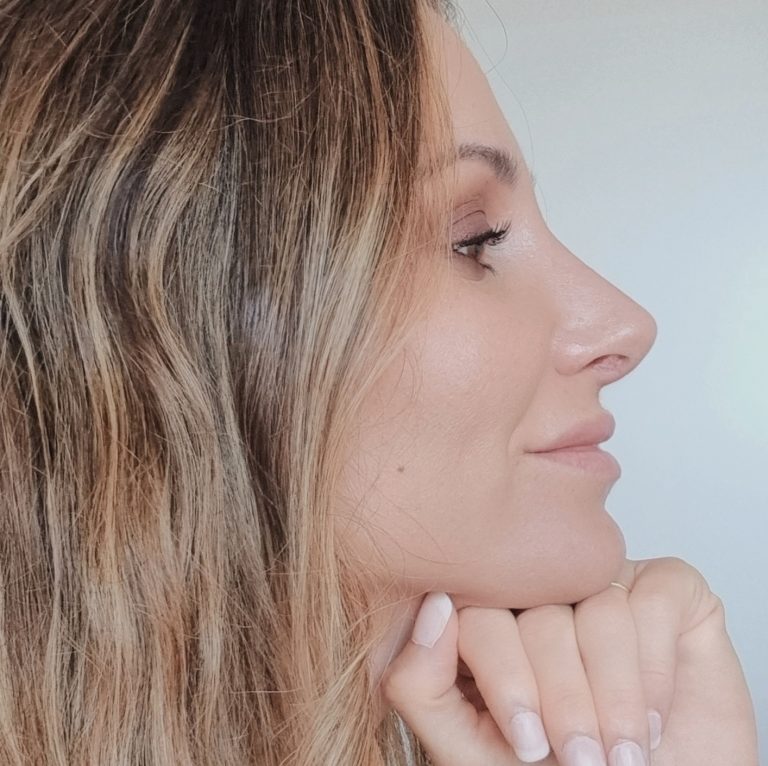 Mi Rinoplastia ultrasónica con el Dr. Blas García