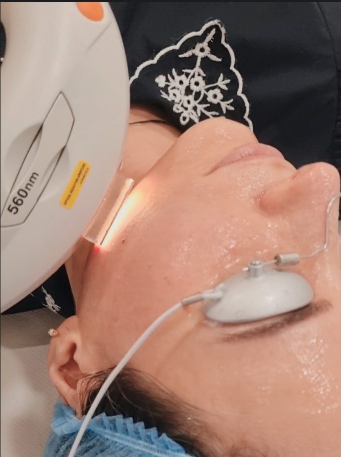 Luz Pulsada Intensa IPL manchas solares. Opinión, experiencia, antes y después quitar manchas piel con laser IPL Clínica Ortega y Gasset.