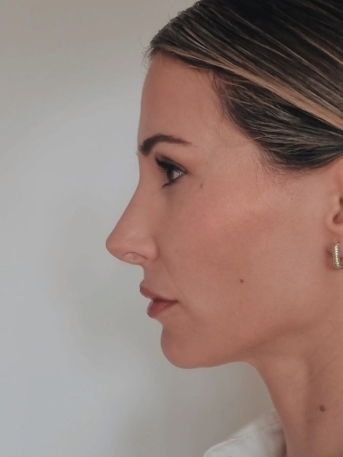 ¿Rinoplastia o rinomodelación? Mi experiencia, opiniones, diferencia, precio. Cuál es mejor, la rinomodelación o rinoplastia?