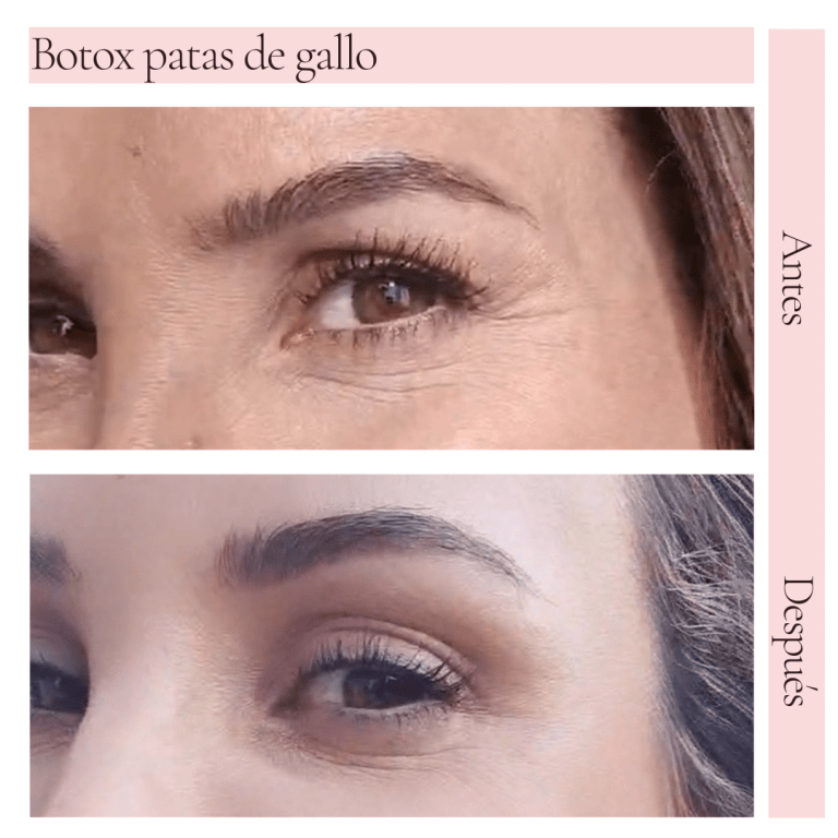 Botox: Mi experiencia, opinión y el antes y después