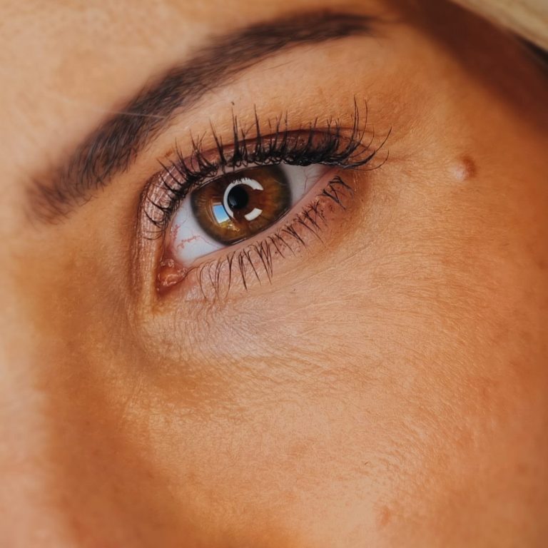 Ojeras, ácido hialurónico y cómo eliminarlas: mi experiencia