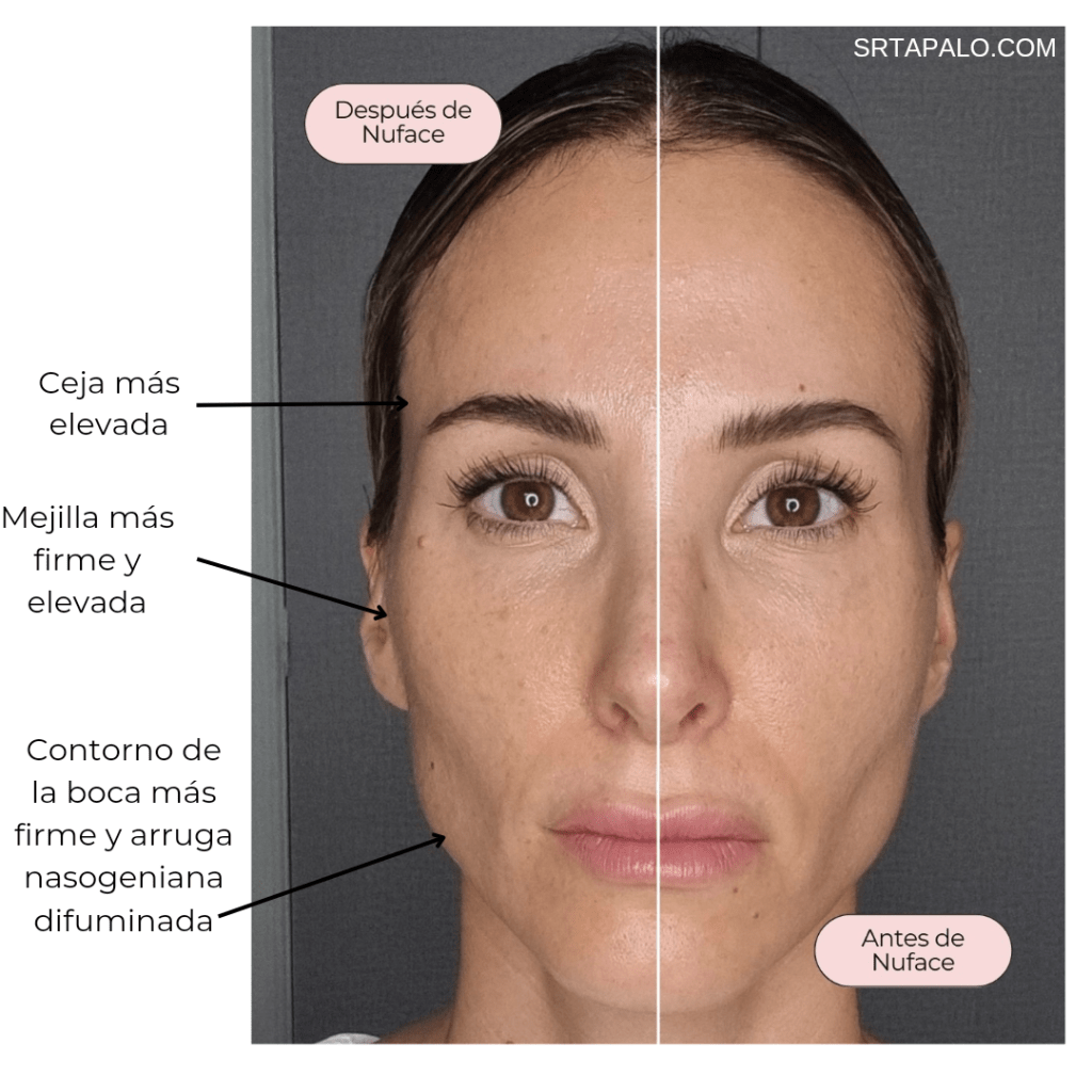 Nuevo Nuface Mini+ y Trinity+. Dispositivo de microcorrientes para casa, lifting facial. Mi opinión, diferencias y fotos de antes y después.