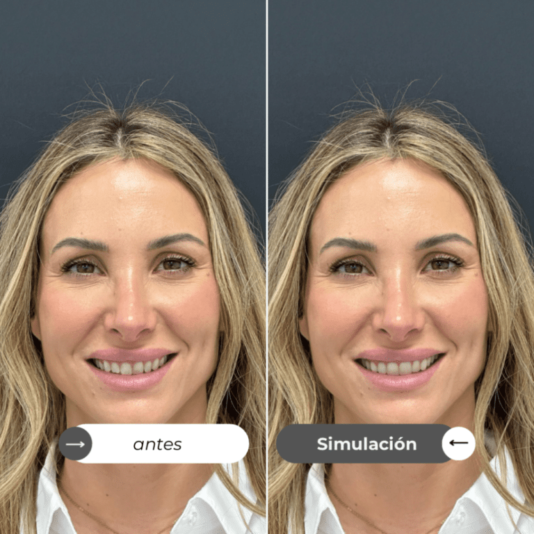 Invisalign, Doctor Smile… Mi ortodoncia invisible en Madrid Invisalign, Doctor Smile… Mi ortodoncia invisible en Madrid